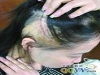 小孩脱发
