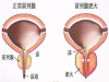 导致少精因素中前列腺炎会导致吗？南阳天伦医院专家厉害吗？