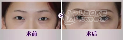 成都纬度新医美表示割双眼皮的价格并不是固定的_0