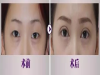 成都纬度新医美表示割双眼皮的价格并不是固定的
