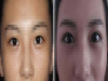 纬度新医美科普割双眼皮不开眼角是种什么体验