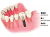 欧丹口腔优质杭州牙齿整形专业销售，品质好，值得信赖