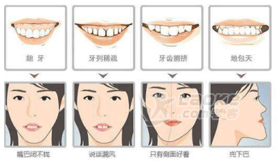 矫正为什么要拔牙？不拔可以吗？_1