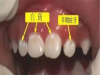 了解蛀牙的五大病变阶段，轻松判断蛀牙