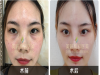 武汉美妍高科去眼袋价格