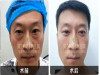 中年人眼袋怎么去除
