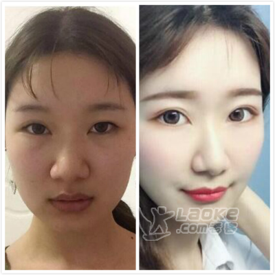 紫馨颜玲：眼部整形割双眼皮方式？国内整形大咖颜玲双眼皮案例_0