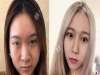 广州紫馨李政佑医生怎么样?做双眼皮手术效果怎么样呢?案例
